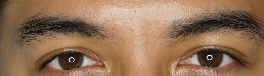 After PicoWay eyebrow tattoo removal at Neoderma: the blue-gray pigment cleared, natural brow hair still in place