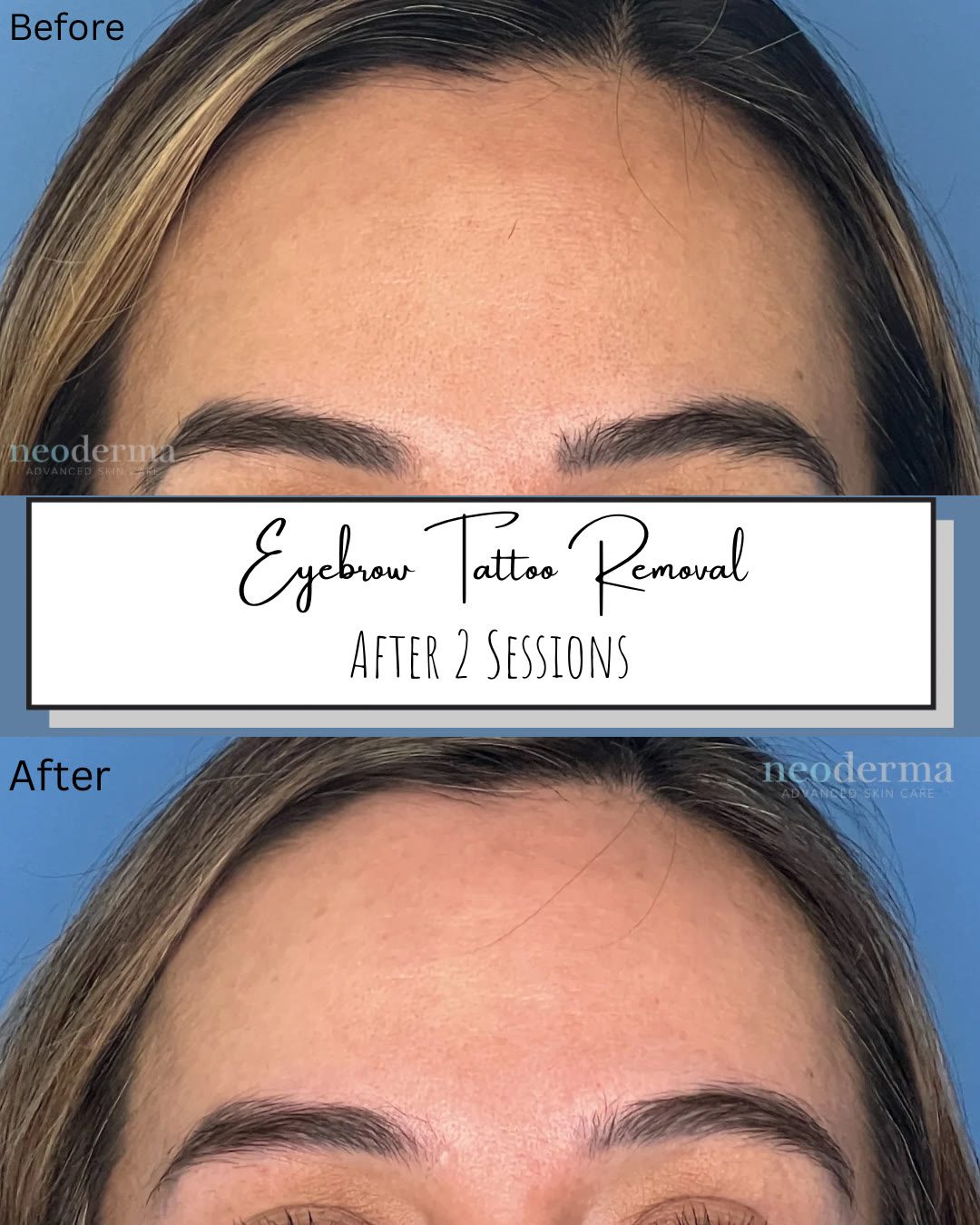 Before and after two PicoWay sessions at Neoderma in Anaheim: a dense eyebrow tattoo faded back to a natural-looking brow