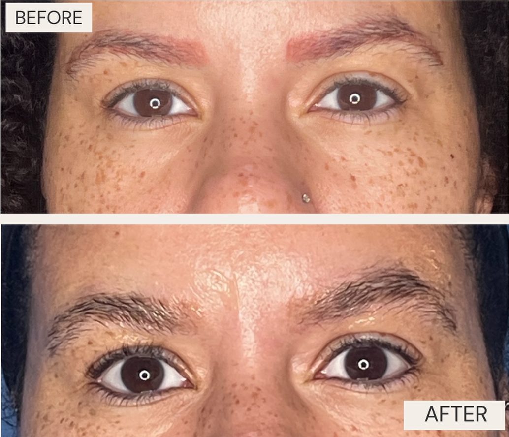 Before and after eyebrow tattoo removal at Neoderma in Anaheim: This patient had one session of laser removal elsewhere that left the red pigment behind. Before and after treatment at Neoderma