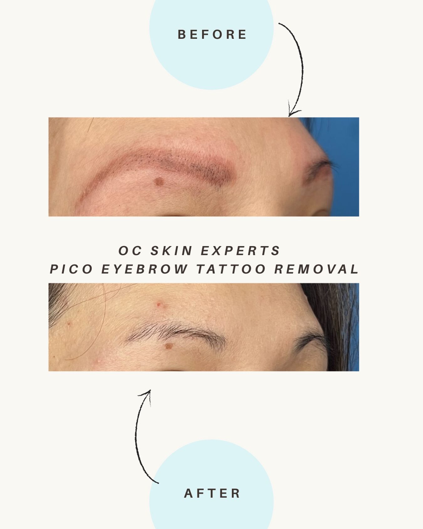 Before and after eyebrow tattoo removal at Neoderma in Anaheim: Red brow ink before and after PicoWay eyebrow tattoo removal